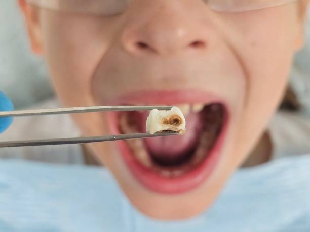 Best Emergency Dental Care for Broken or Chipped Teeth in Ashwaubenon, WI
